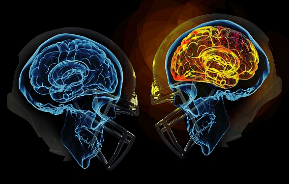 The Football Player's Brain That Sparked the NFL's Concussion Crisis - The  Atlantic